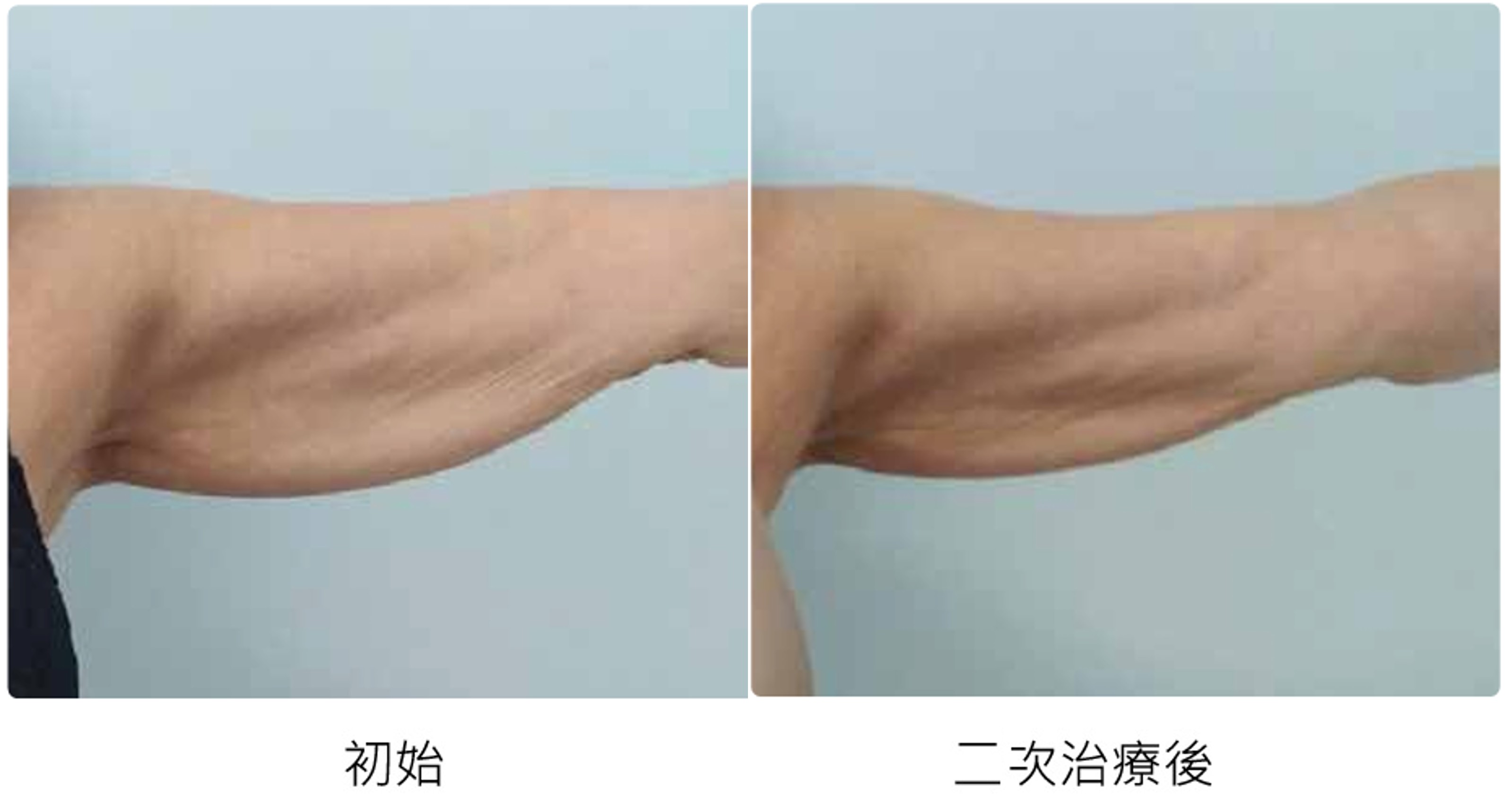 手臂